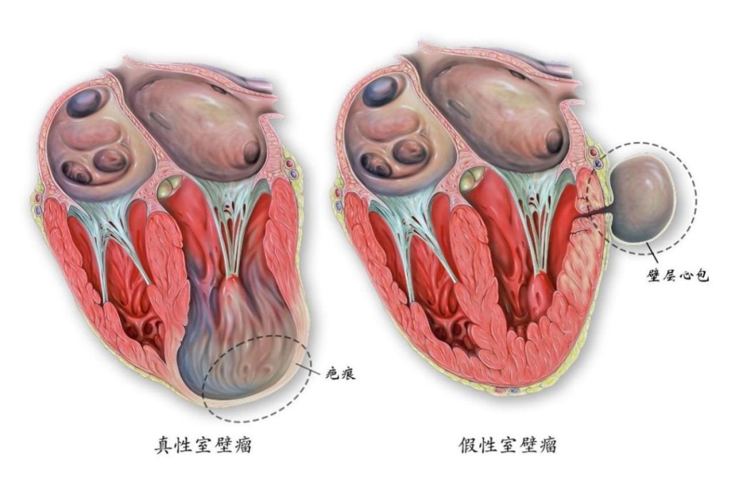 心血管此瘤非彼瘤之一——心脏室壁瘤