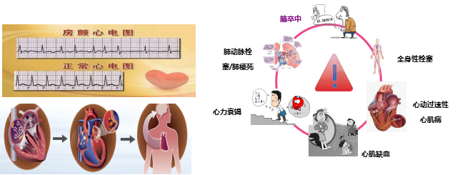 脉冲消融——房颤治疗新武器