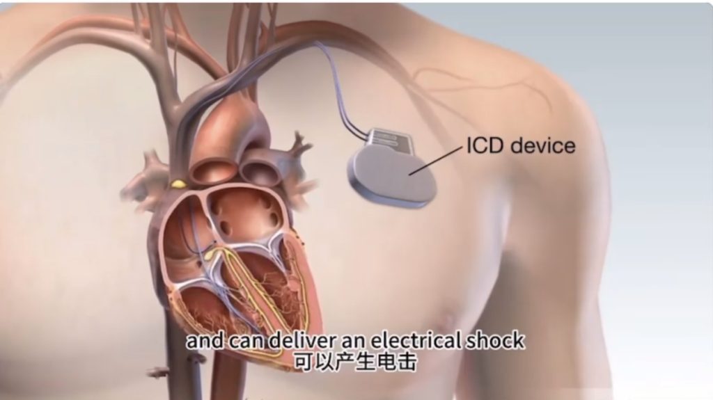 守护心跳的“隐形卫士”——ICD（植入式心律转复除颤器）