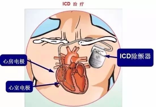 守护心跳的“隐形卫士”——ICD（植入式心律转复除颤器）