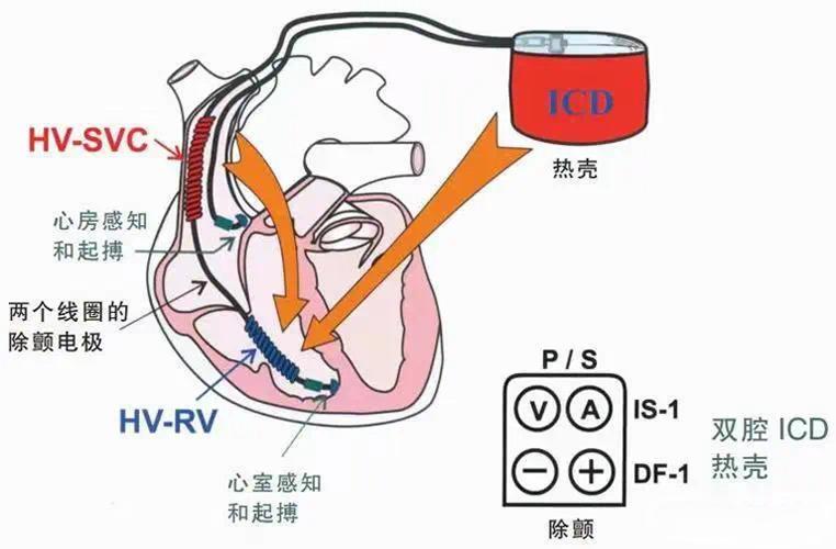 守护心跳的“隐形卫士”——ICD（植入式心律转复除颤器）