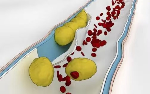关于“血脂”的深度探讨——医患对话